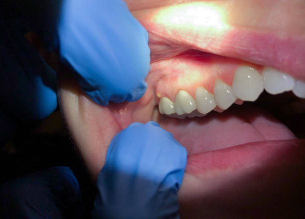 Best Emergency Broken Tooth Repair in Sunnyside, GA